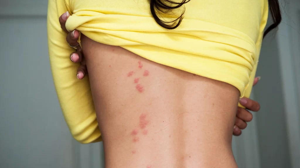 Štípance od štěnic