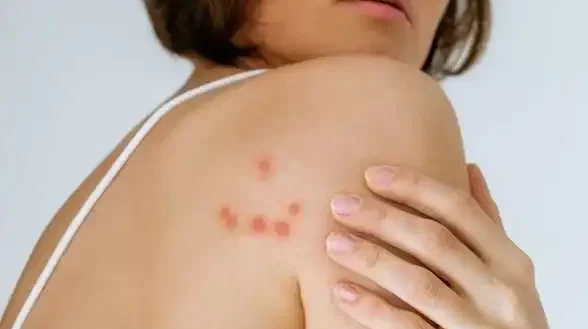 Jak rozeznat štípance od štěnic